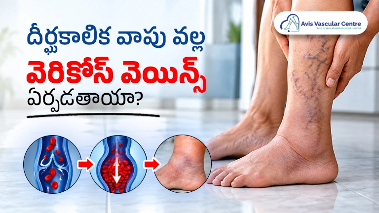 how-to-identify-varicose-veins-at-home