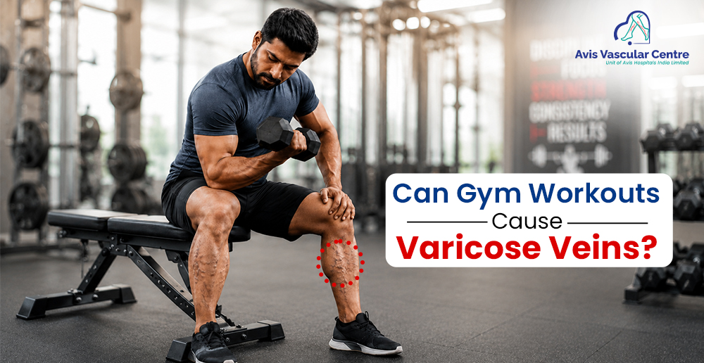 gym varicose veins