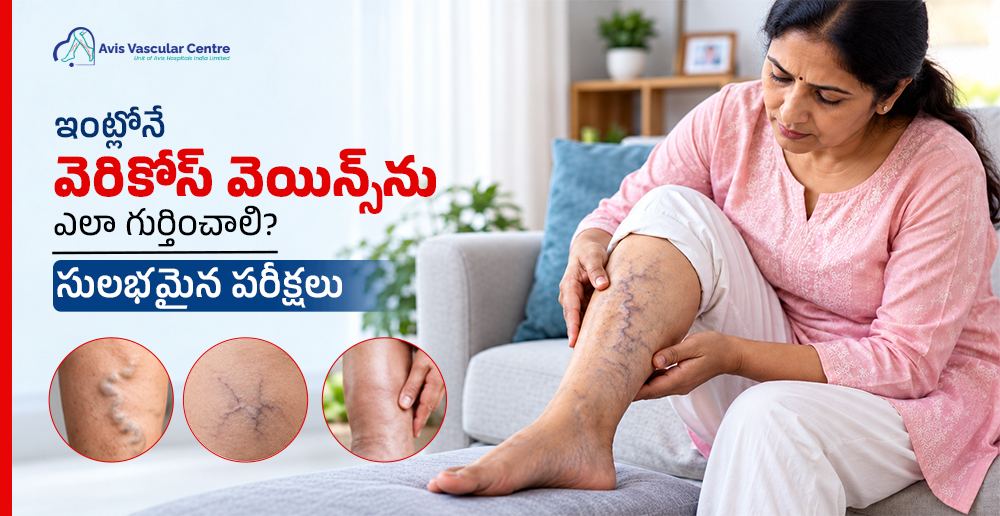 how-to-identify-varicose-veins-at-home