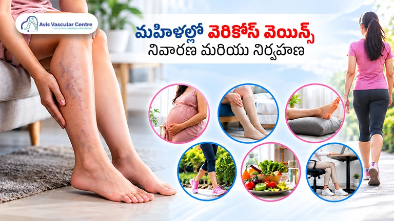 how-women-can-prevent-varicose-veins