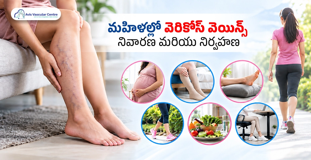 how-to-identify-varicose-veins-at-home