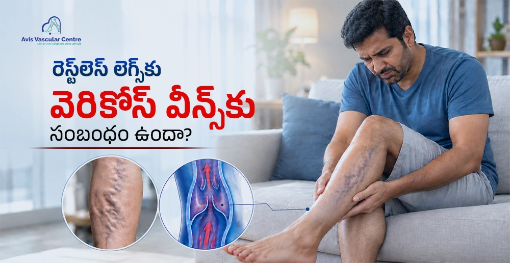 restless-legs-and-varicose-veins-connection