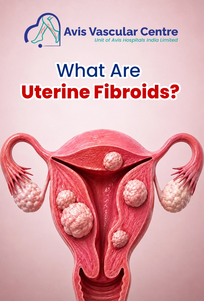 uterine-fibroids