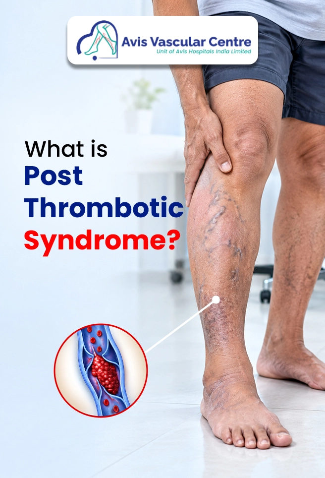 what-is-post-thrombotic-syndrome