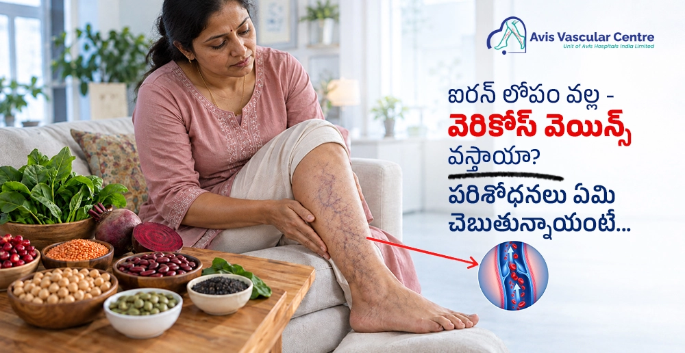 ఐరన్ లోపం వల్ల వెరికోస్ వెయిన్స్
