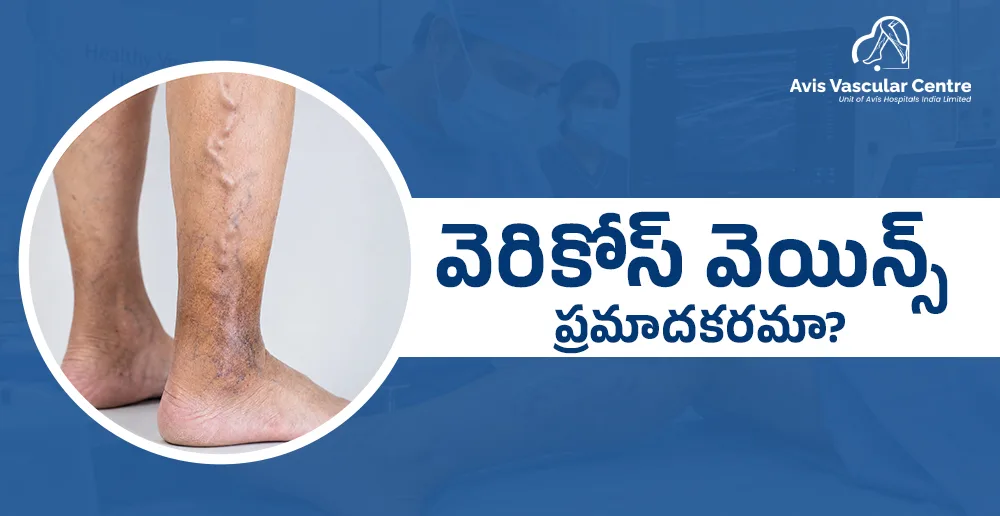 మానసిక-ఆందోళన-వెరికోస్-వీన్స్